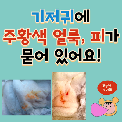  기저귀에 주황색 얼룩, 피가 묻어 있어요!(신생아 요산뇨, 가성 생리, 가성 월경)