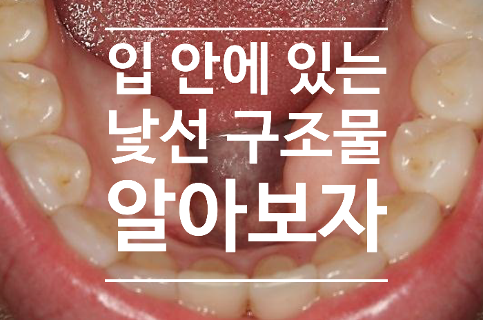 연조직 질환 1. 입안에 뭐가 자라나고 있어요? 괜찮은 건가요? 토러스(torus), 침샘관(parotid duct), 혀유두(tasting buds)