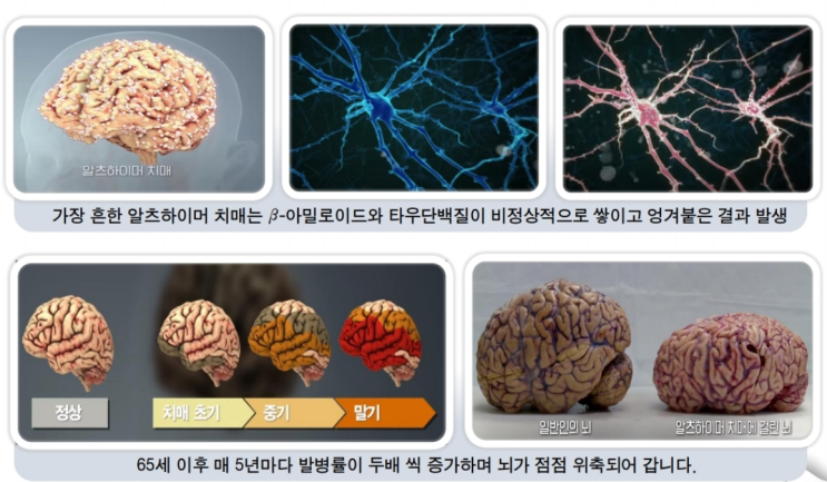  피플라이프 보험클리닉 최근 급증하는 치매를 대비한 치매보험