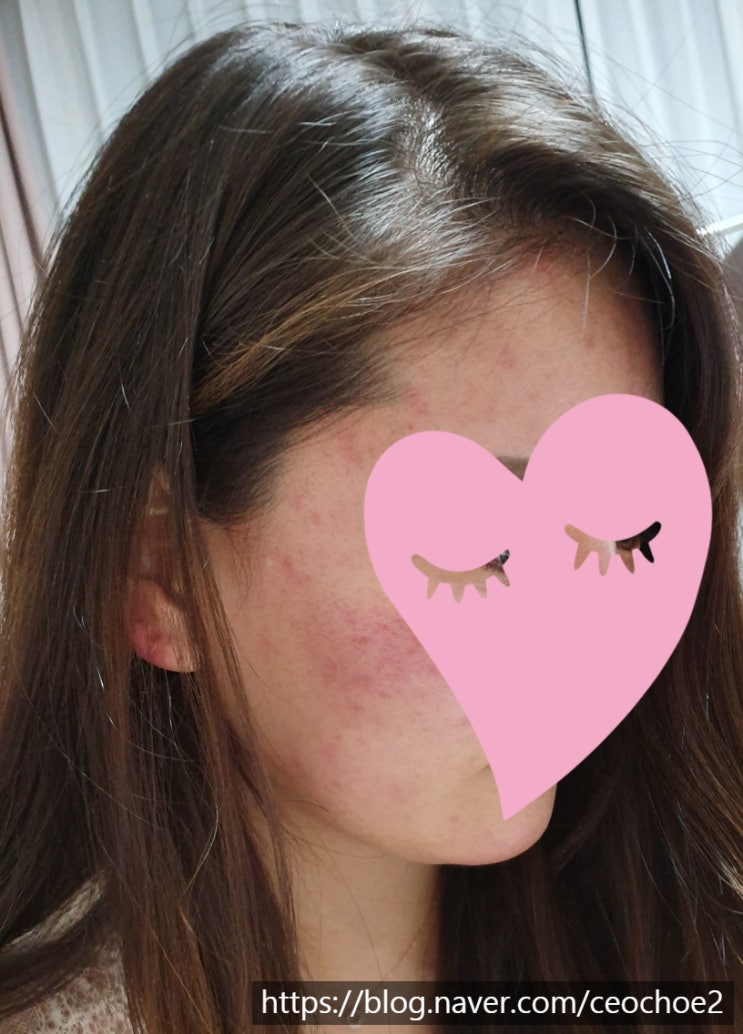  임신10주차 계류유산 후 몸조리 중...2차 수술을 받으라고요?