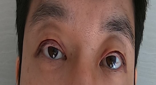  쌍수후관리의 모든 것, 쌍수후 렌즈, 화장, 머리감기...