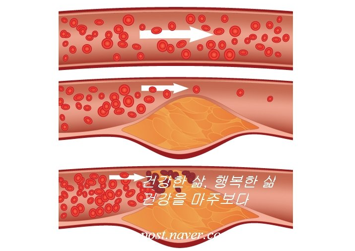  고지혈증에 좋은 10가지 음식