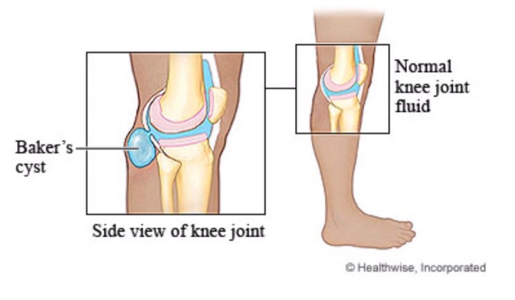 [질병 정보] 베이커씨 낭종 (Baker’s cyst) - 무릎 뒤쪽으로 물혹이 만져진다면 의심해보세요. (증상, 진단, 치료, 예방)