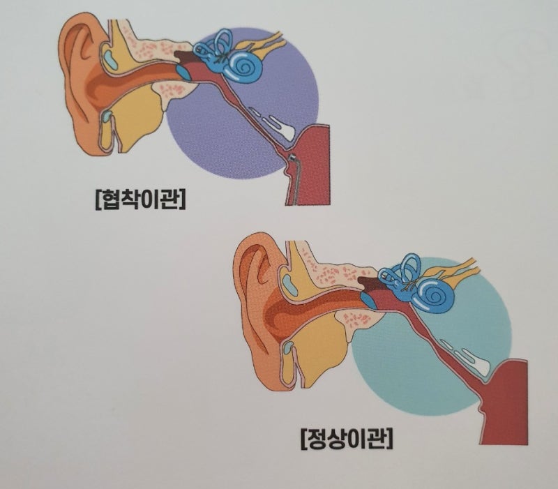 이관풍선 확장술
