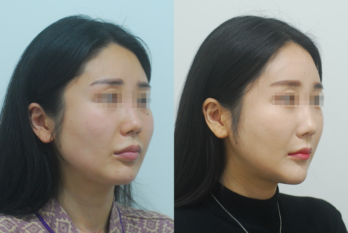 옆볼이 패이면 나이들어 보이는 이유~ 지방이식과 흡입 필요성 : 케이라인 자주묻는질문 광대축소후 볼처짐, 사각턱 수술후 살처짐 -> 윤곽 재수술, 광대 재교정 6개월 : 네이버 블로그” style=”width:100%” title=”광대축소후 볼처짐, 사각턱 수술후 살처짐 -> 윤곽 재수술, 광대 재교정 6개월 : 네이버 블로그”><figcaption>광대축소후 볼처짐, 사각턱 수술후 살처짐 -> 윤곽 재수술, 광대 재교정 6개월 : 네이버 블로그</figcaption></figure>
<figure><img decoding=