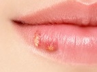  구순 포진 (입술 포진) 증상 및 원인