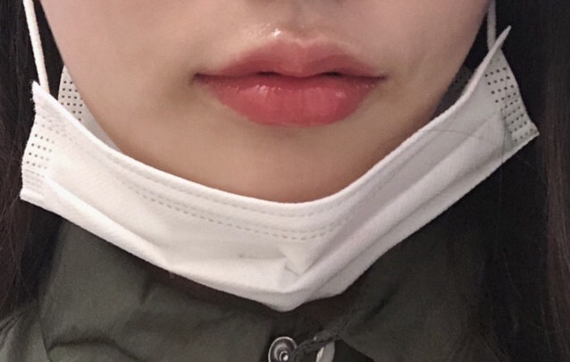 내돈내산 입술필러, 입꼬리 보톡스, 입꼬리필러 후기 : 네이버 블로그