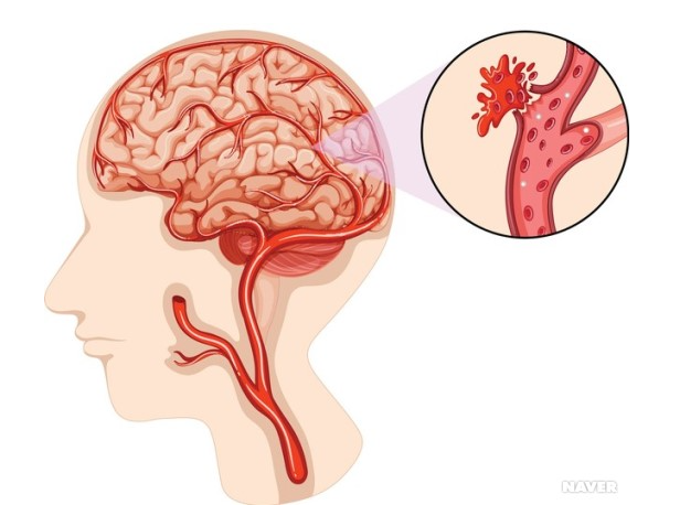 뇌의 동맥 질환 뇌일혈