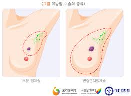 유방암 절제수술치료 암진행단계 생존률예후:보조요법 간호학의학케이스 유방암 절제수술치료 암진행단계 생존률예후:보조요법 간호학의학케이스