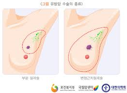 유방암 절제수술치료 암진행단계 생존률예후:보조요법 간호학의학케이스