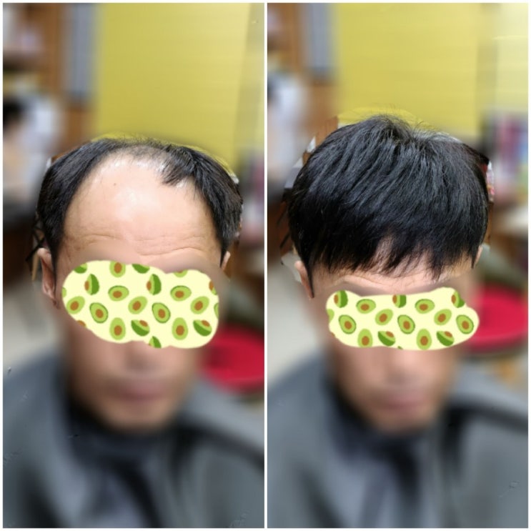  탈모중기 보톡스증모술로 스타일 찾기! 춘천가발ㆍ보톡스증모전문점(비용공개)