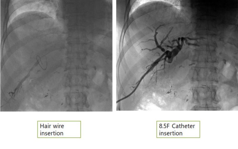 PTBD(Percutaneous Transhepatic Bile/Biliary Drainage, 경피경간담즙배액술) : 네이버 블로그