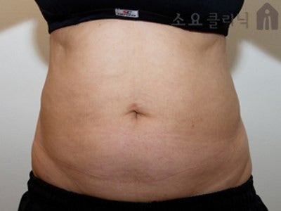 [강남지방흡입 부작용 복부지방흡입유착 강남다이어트클리닉] 이오팻주사 6