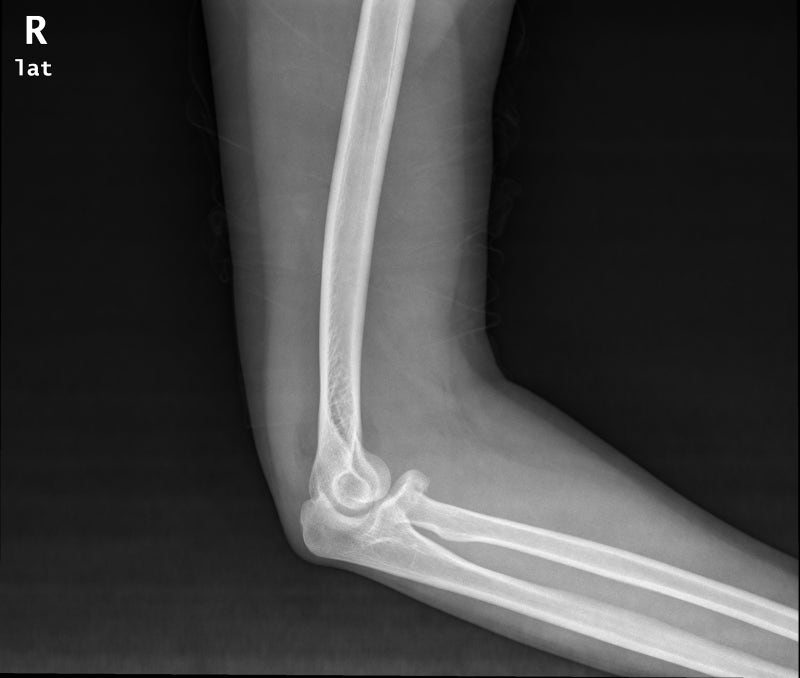 팔꿈치 바깥쪽 골절, 팔꿈치 요골 머리 골절, radial head fracture, radial neck fracture ...