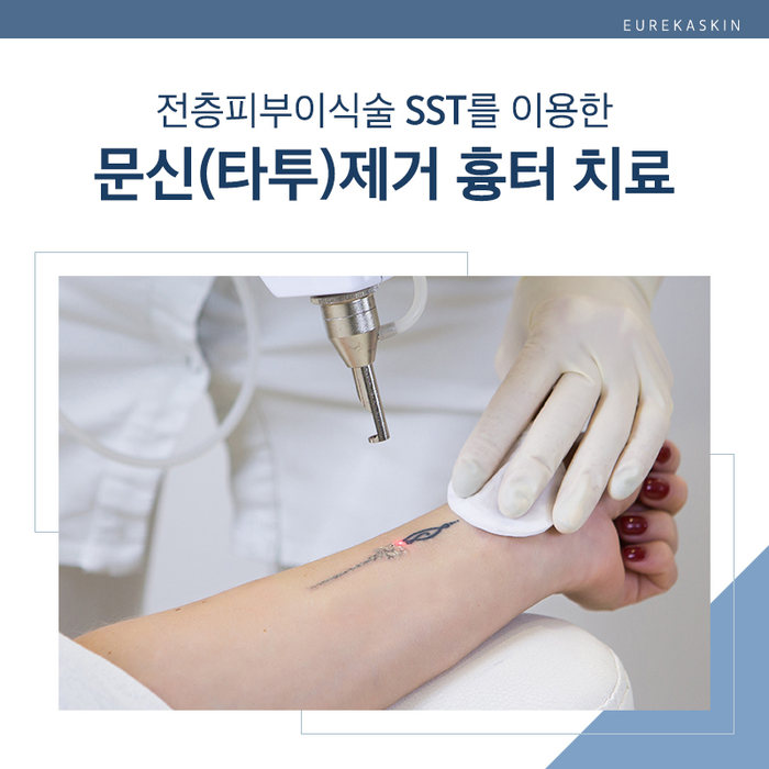 문신(타투)제거 흉터 치료에 탁월한 전층 피부이식술 SST