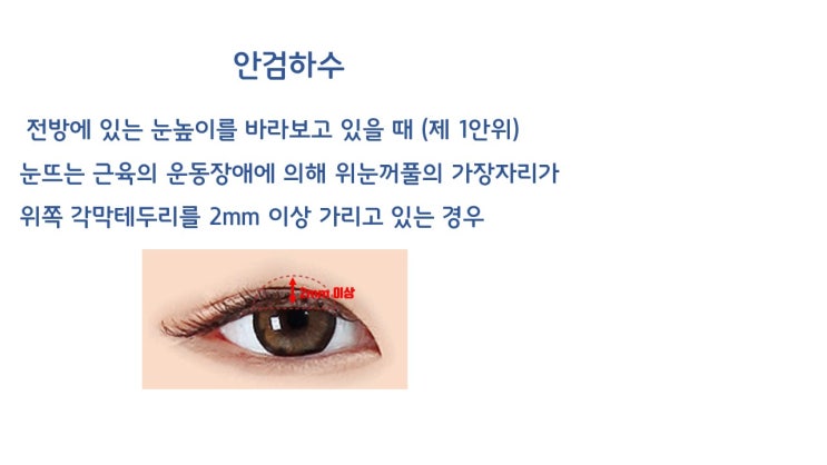  눈매교정 전 안검하수 증상 부자 이박사 눈으로 공부!!!