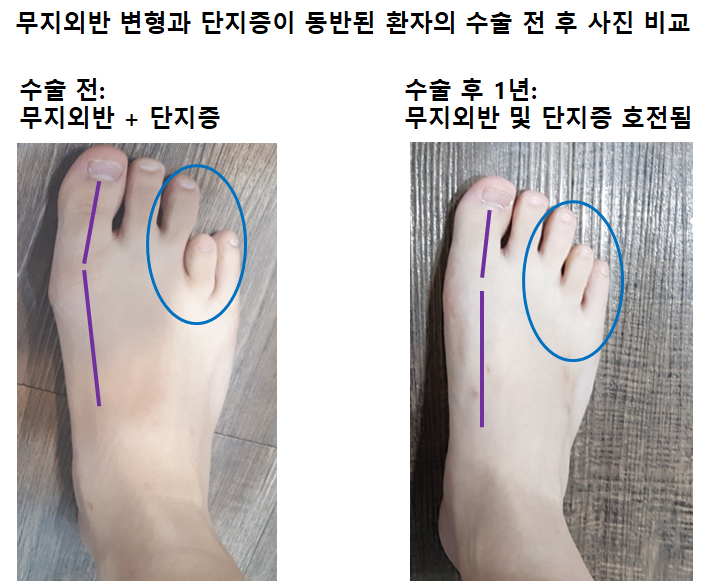 무지외반증과 동반된 네번째 발가락 단지증의 수술 실제 사례: 엄지발가락 내측이 아프고 발가락이 짧아서 부끄러워요. 같이 고칠 수 ...