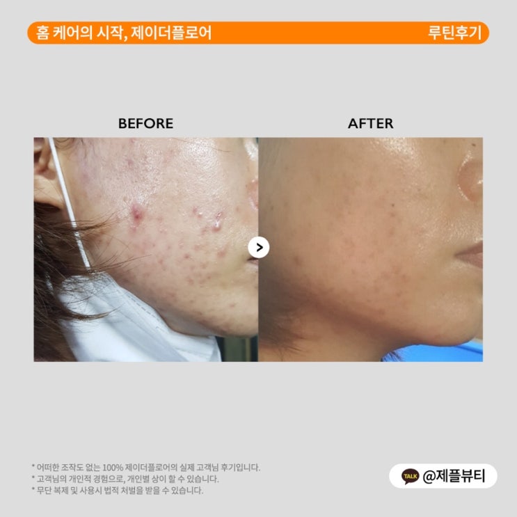  홍조세럼 !!!! 윤곽 마스크팩 ! 염증성 피부 언니들 진짜 꼭꼭 필독 ️