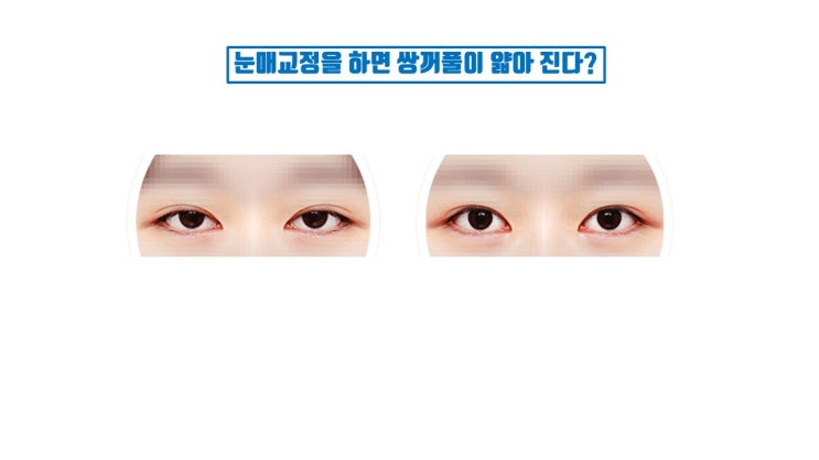  눈매교정전후 쌍수 얇아 짐은 반드시 생기나?