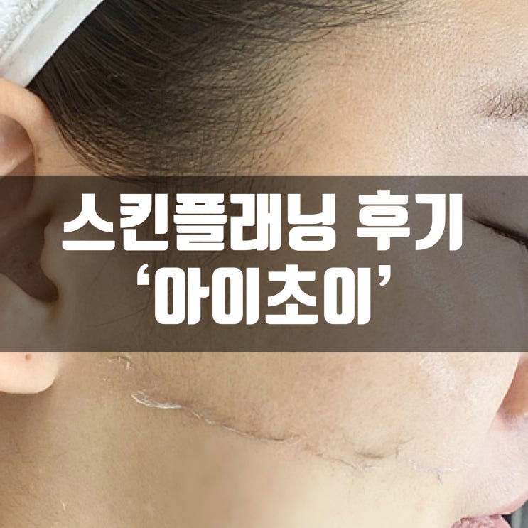  서면 스킨플래닝 아이초이에서 스킨플래닝 받고 10분만에 피부톤업 주의사항 포함