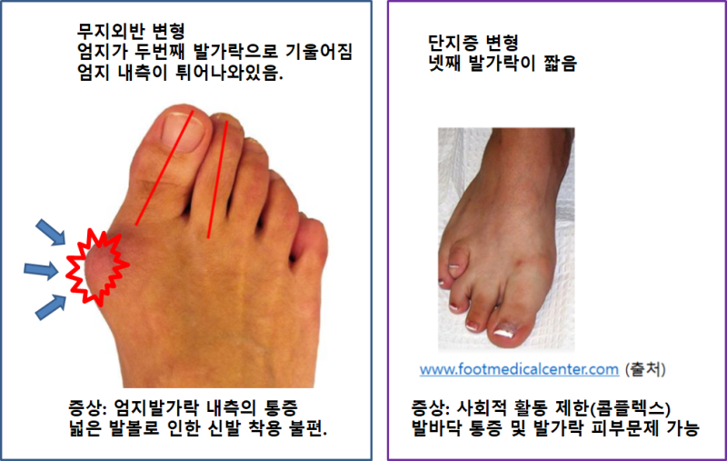 무지외반증과 동반된 네번째 발가락 단지증의 수술 실제 사례: 엄지발가락 내측이 아프고 발가락이 짧아서 부끄러워요. 같이 고칠 수 ...