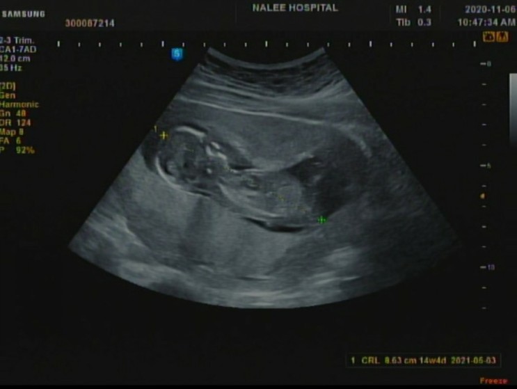 남편이 쓰는 임신일기 [8] (임신 13주 - 철분제, 산후조리원 예약)