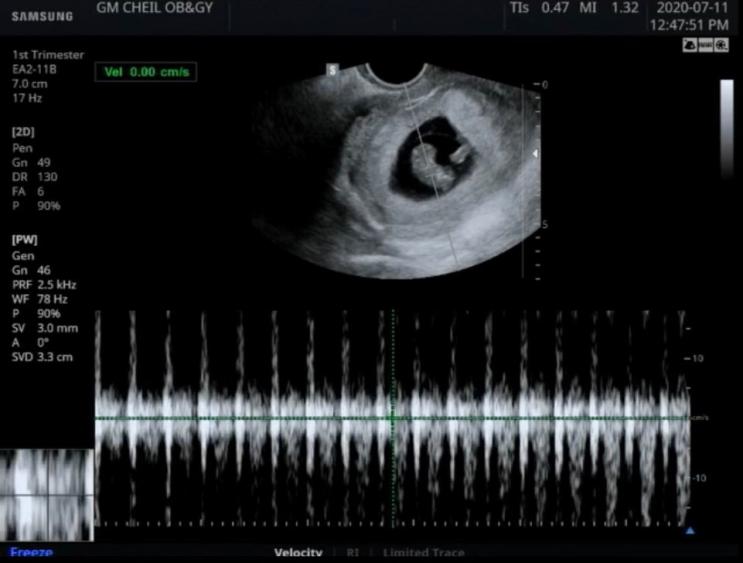 [임신일기] 임신 8주 10주차 증상 초음파 + 산전검사 바우처 사용 가격