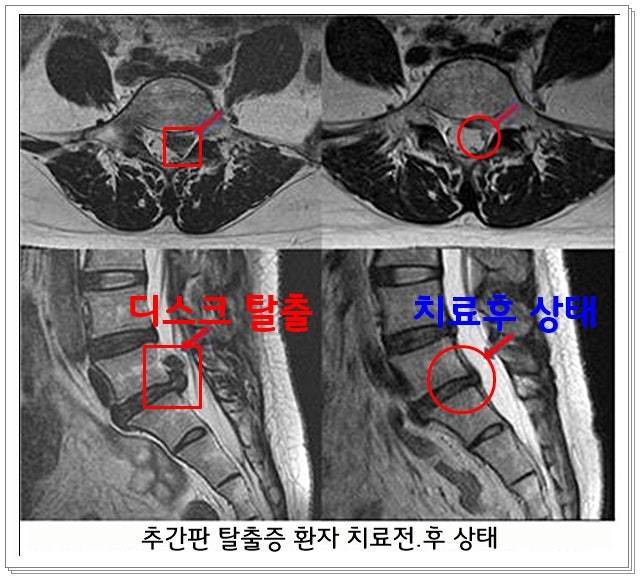태아보험 추간판장애수술에 대해서 알아보겠습니다. : 네이버 블로그