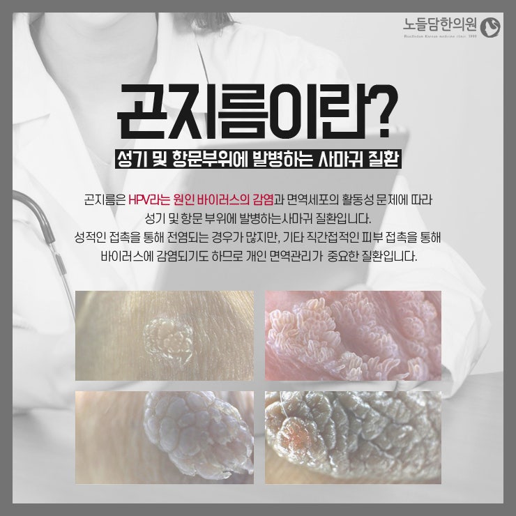 질 입구 돌기, 단순 뾰루지처럼 대했는데 : 네이버 블로그