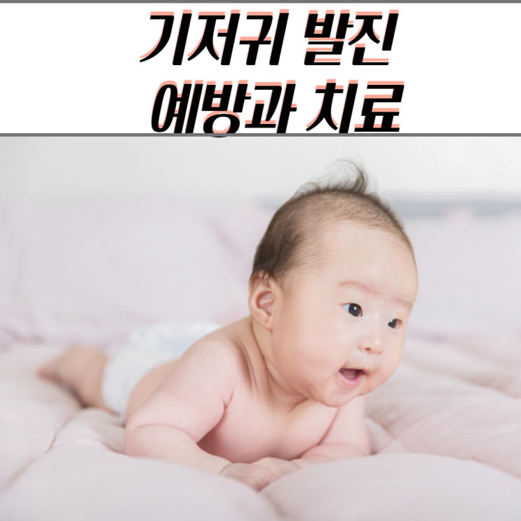 아기 기저귀 발진 원인과 치료방법