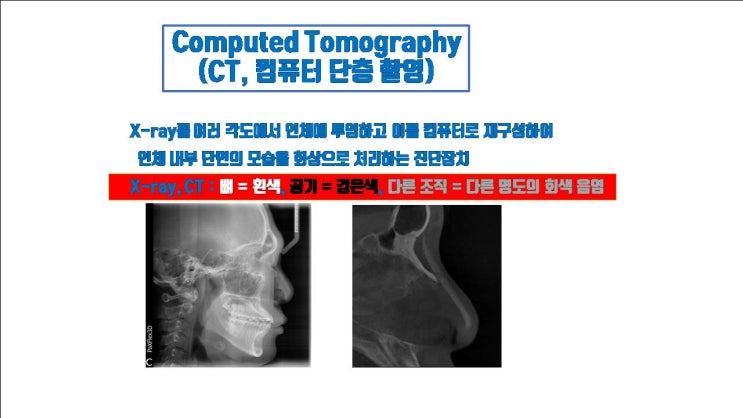  3D CT 코성형은 절대로 연골, 고어텍스보형물, 메드포어를 보여 주지 않아요ㅠㅠ