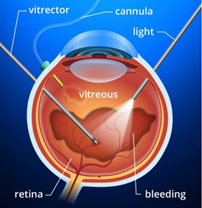  TPPV (Trans Pars Plana Vitrectomy