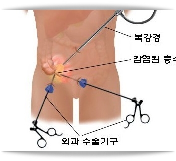  맹장염 초기증상 및 원인(충수염)