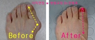  무지외반증과 심한 건막류
