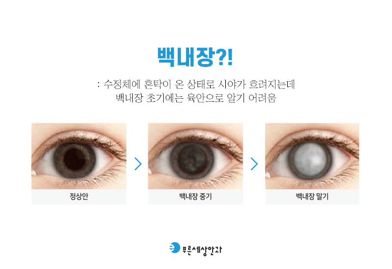 녹내장 백내장의 차이를 알아보려면
