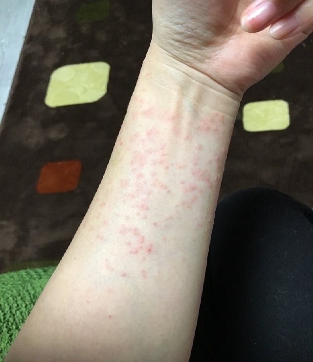가정보육 일주일 기록 발열 후 두드러기