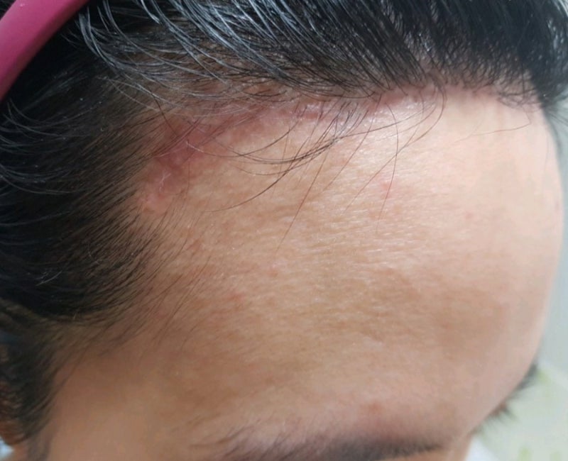 이마 축소 수술 후기(회복 기간, 상처, 비용), 이마 반M자 탈모 탈출기. 5