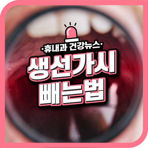  목에 생선가시 빼는법! 내과 내시경?