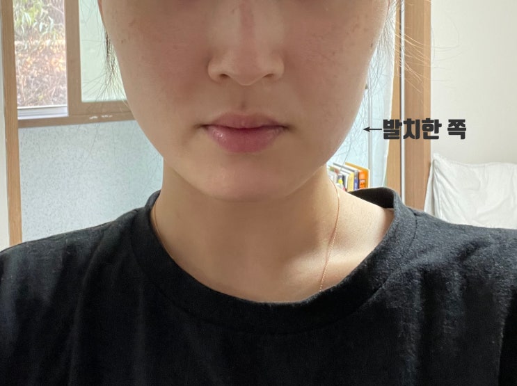  매복 사랑니 발치 후기, 2~3일차