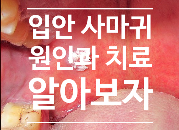 연조직질환 2. 입안에 사마귀가 생겼어요 / 사람유두종바이러스(human papilloma virus; HPV)로 인한 입안의 증식물, - 편평사마귀, 심상성사마귀 연조직질환 2. 입안에 사마귀가 생겼어요 / 사람유두종바이러스(human papilloma virus; HPV)로 인한 입안의 증식물, - 편평사마귀, 심상성사마귀