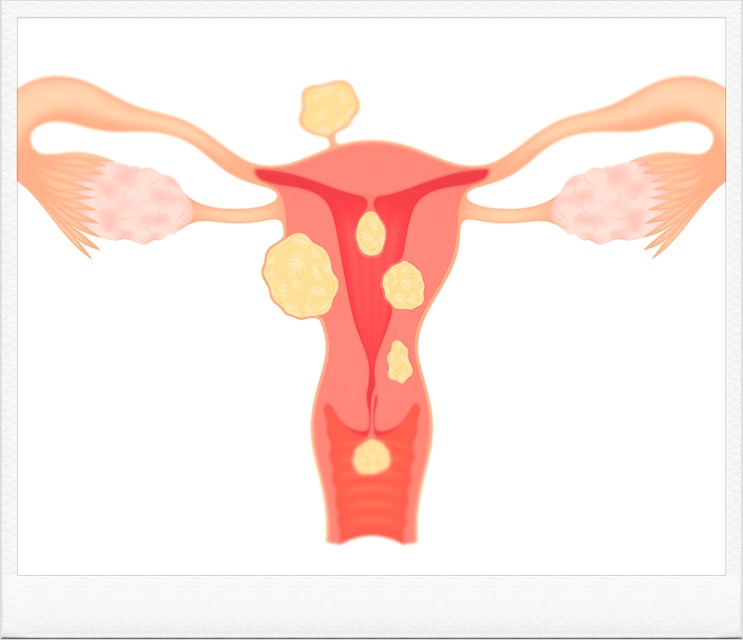  자궁적출수술방법 인터넷으로 찾다 평생 후회합니다