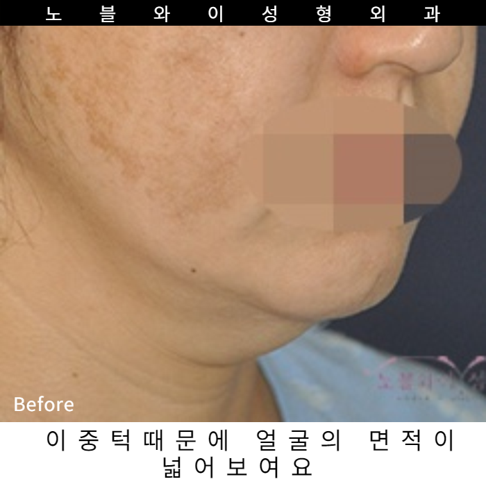  이중턱살빼는방법 다이어트로 안된다면