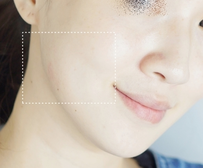 얼굴 가려움증 모낭충 집에서 해결하다