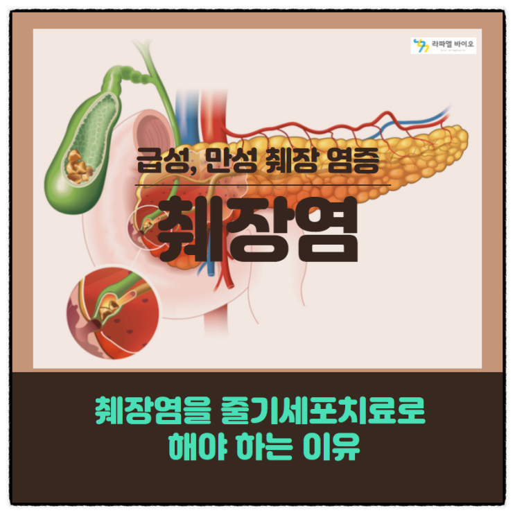 췌장염 원인과 증상 그리고 줄기세포치료를 해야 하는 이유.