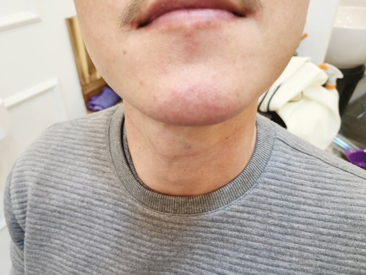  영등포 남자 왁싱 청춘케어, 얼굴 왁싱 비포, 애프터 페이스 왁싱.