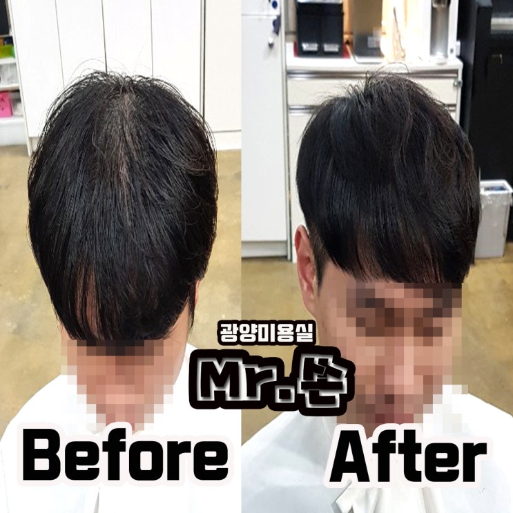  모류교정 ? 모류교정의 힘은 정말 엄청납니다 !! 링거펌전문점 미스터쏜 에서 모류교정 시술하기 ! !