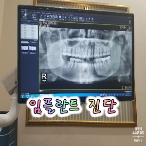  임플란트 시술 과정 1/4일차(진단)
