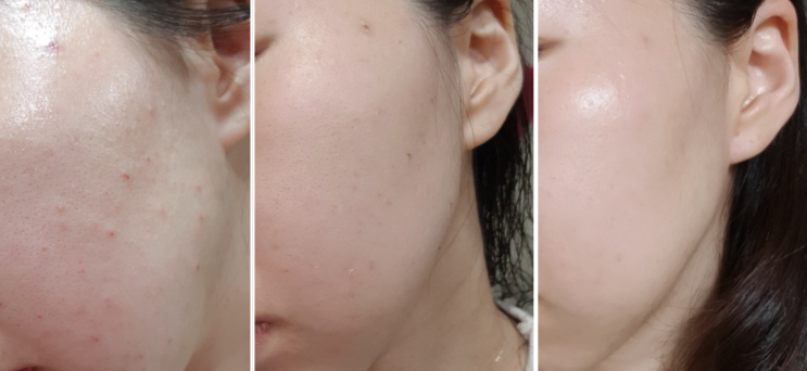  울산 피부과 여드름 압출 잘하는 곳에서 받은 아그네스 레이저 시술 한달 후기