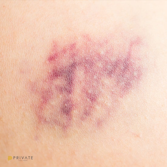 Post-Eye Surgery Precautions 사진 4