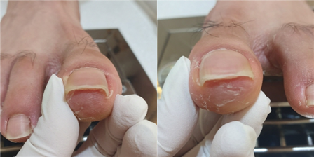 내성발톱 통증은 인천 송도 페디아이티엔에서 해결!